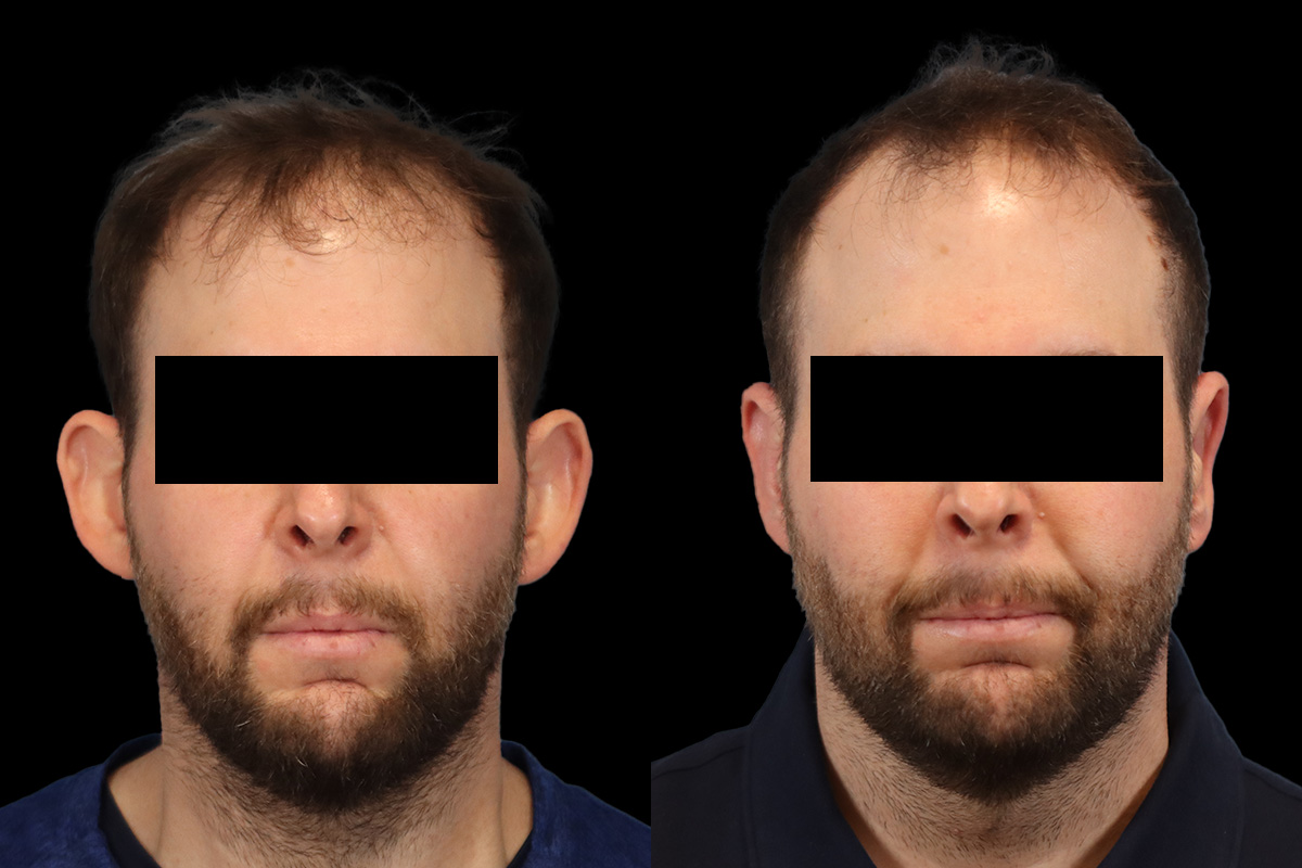 Otoplasty Before and After | Leong Facial Plastic Surgery