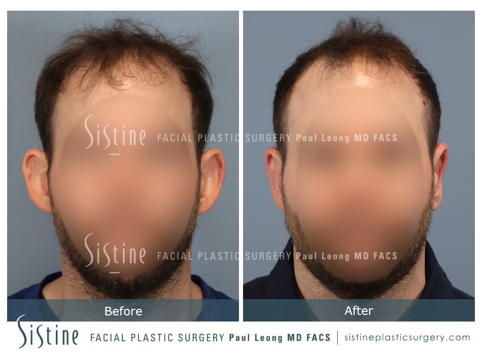 Otoplasty Before and After | Leong Facial Plastic Surgery