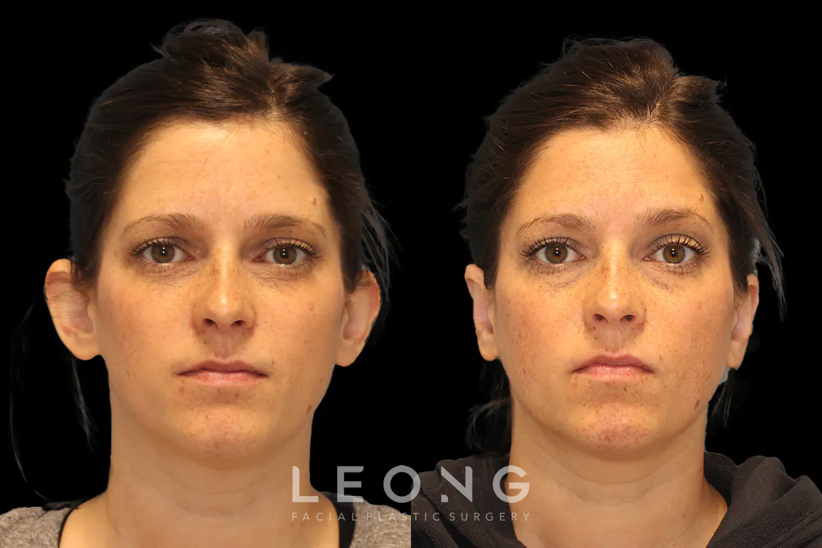 Otoplasty Before and After | Leong Facial Plastic Surgery