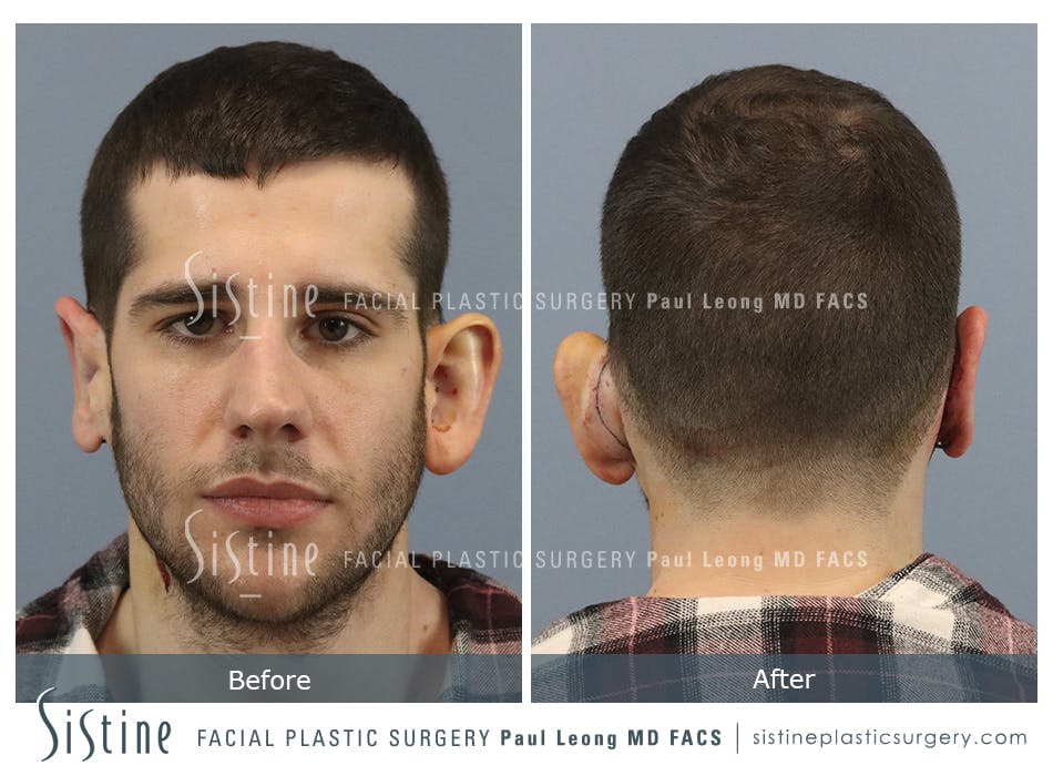 Otoplasty Before and After | Leong Facial Plastic Surgery