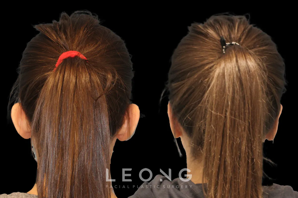 Otoplasty Before and After | Leong Facial Plastic Surgery