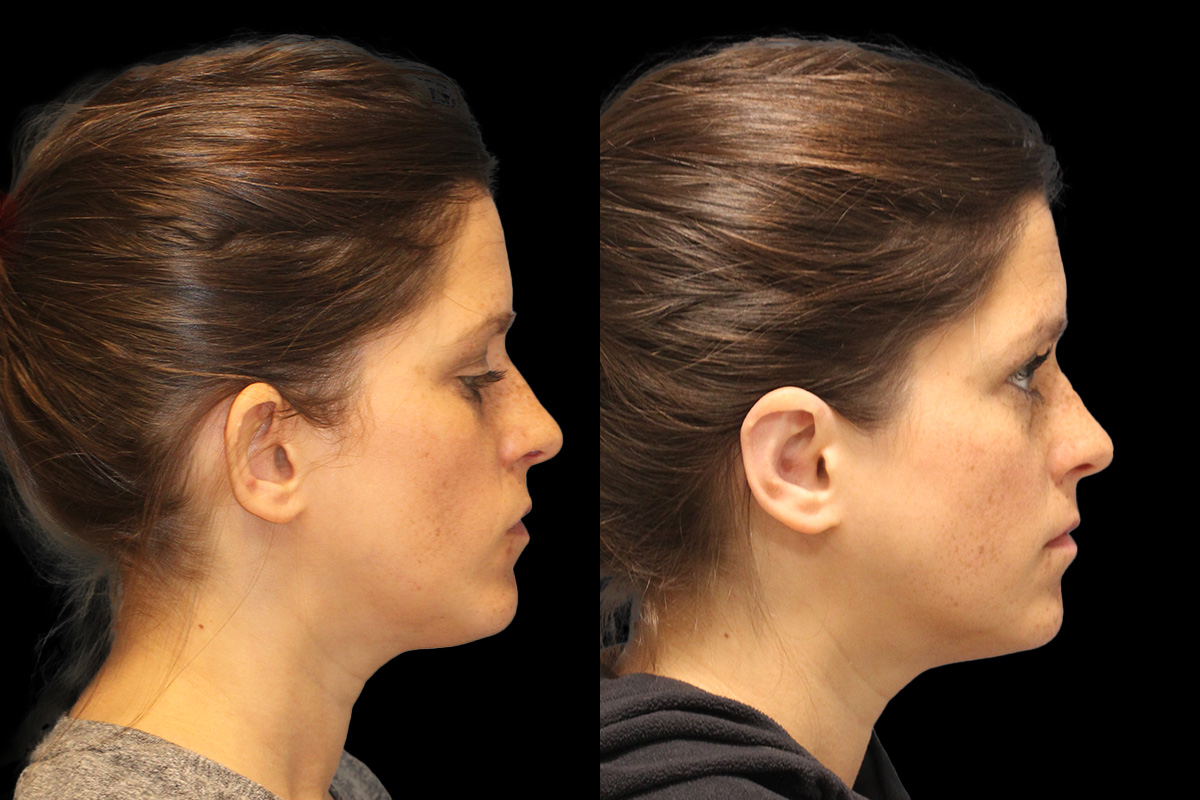 Otoplasty Before and After | Leong Facial Plastic Surgery
