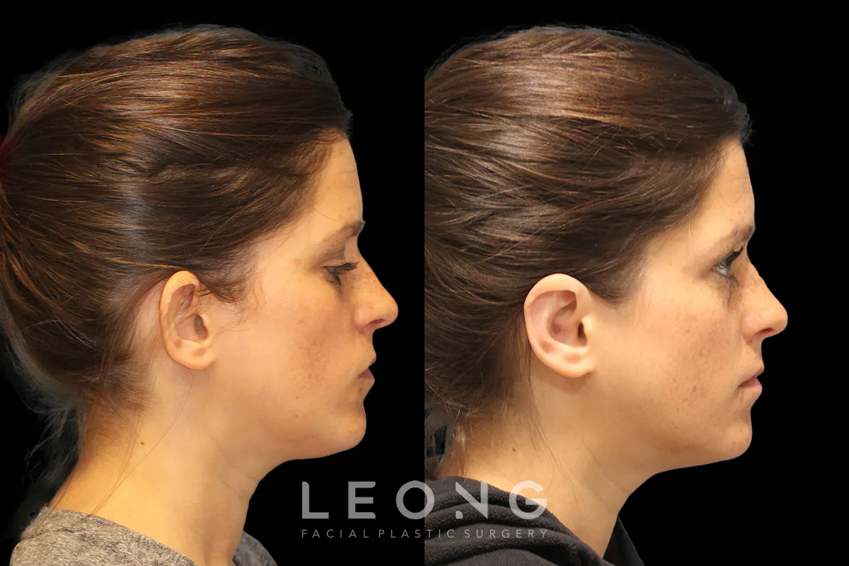Otoplasty Before and After | Leong Facial Plastic Surgery