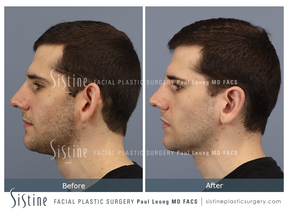 Otoplasty Before and After | Leong Facial Plastic Surgery