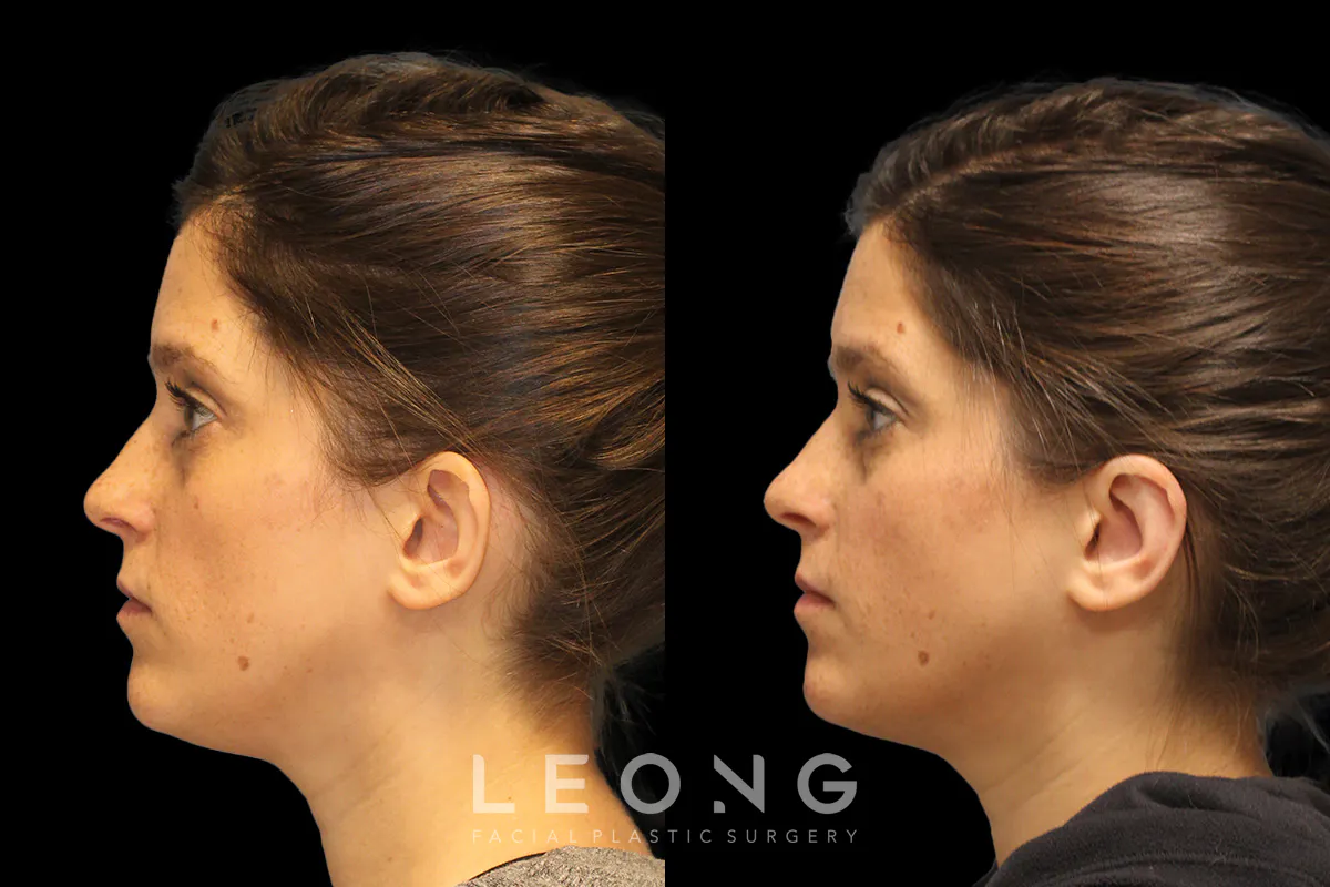Otoplasty Before and After | Leong Facial Plastic Surgery