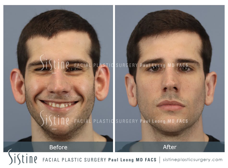 Otoplasty Before and After | Leong Facial Plastic Surgery