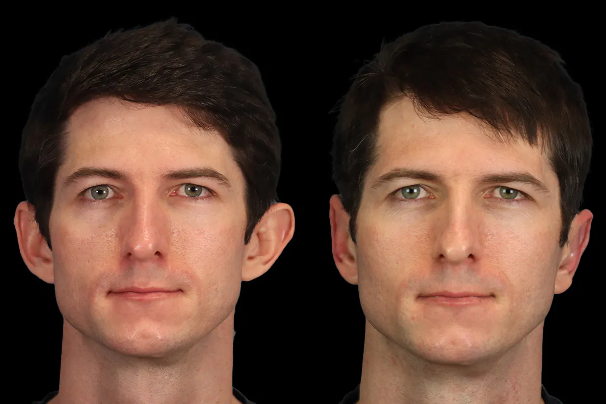 Otoplasty Before and After | Leong Facial Plastic Surgery