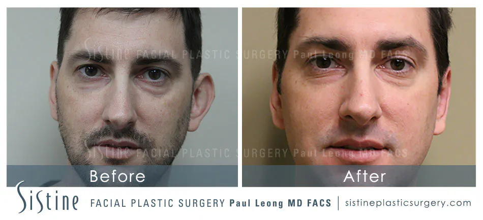 Otoplasty Before and After | Leong Facial Plastic Surgery