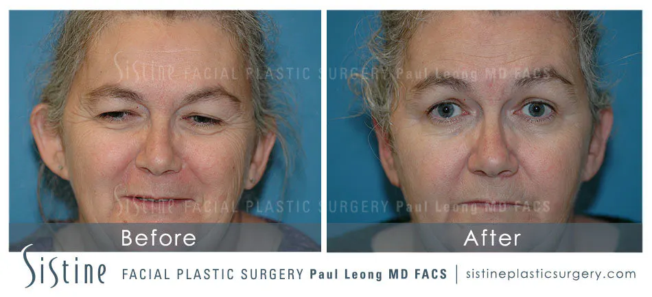 Otoplasty Before and After | Leong Facial Plastic Surgery