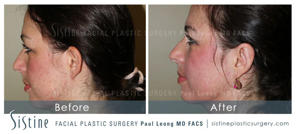 Otoplasty Before and After | Leong Facial Plastic Surgery