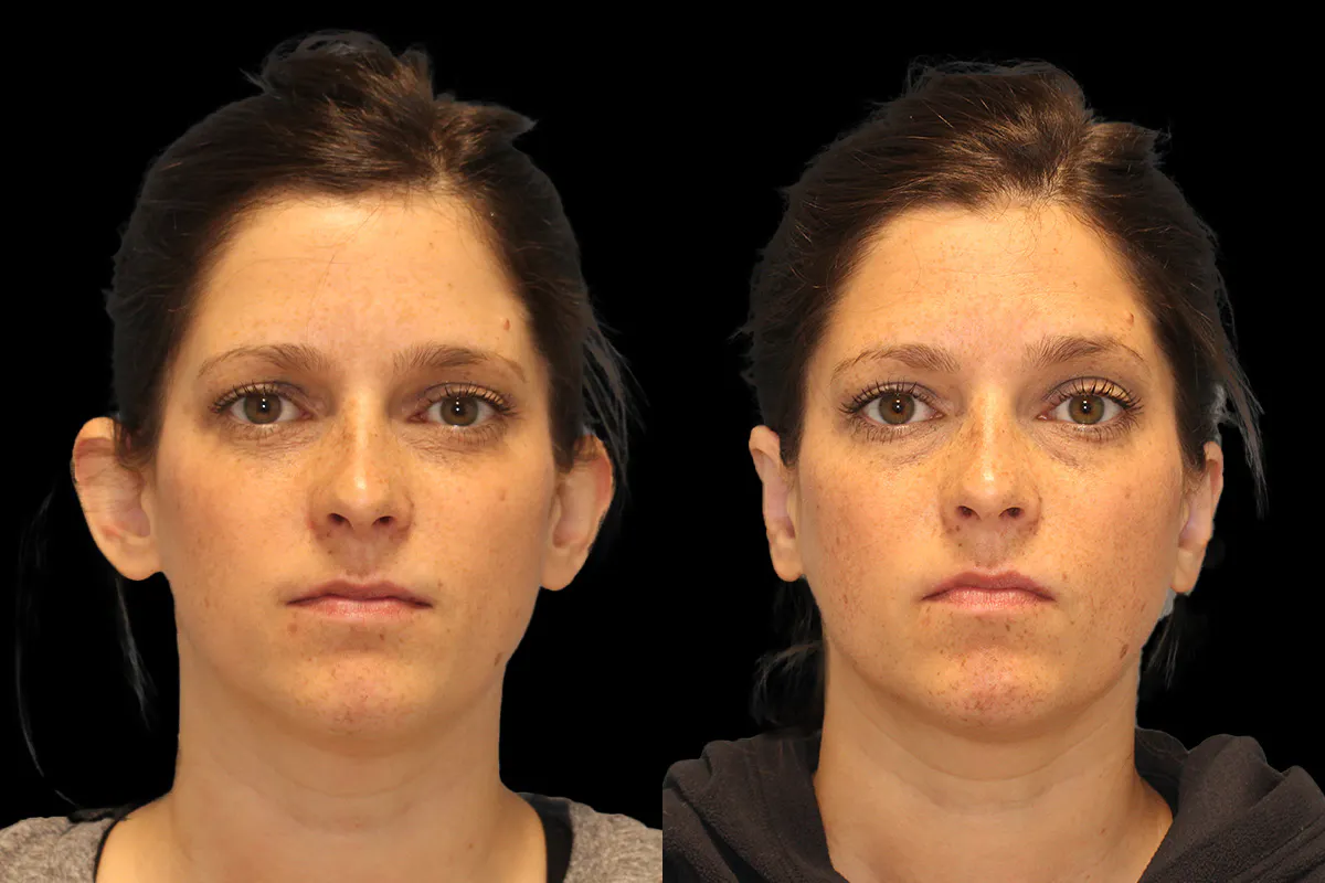 Otoplasty Before and After | Leong Facial Plastic Surgery