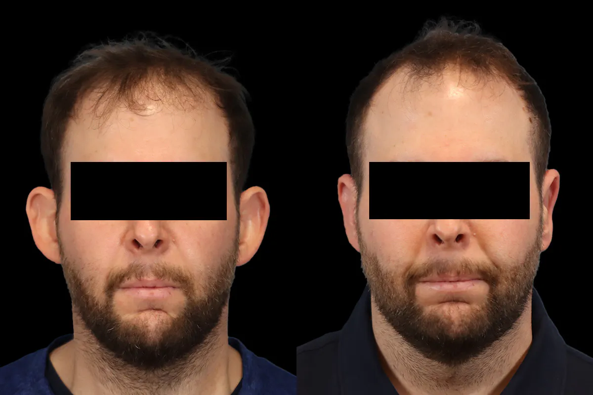 Otoplasty Before and After | Leong Facial Plastic Surgery