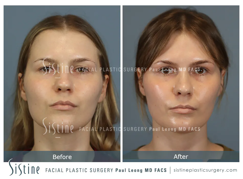 Rhinoplasty Before and After | Leong Facial Plastic Surgery
