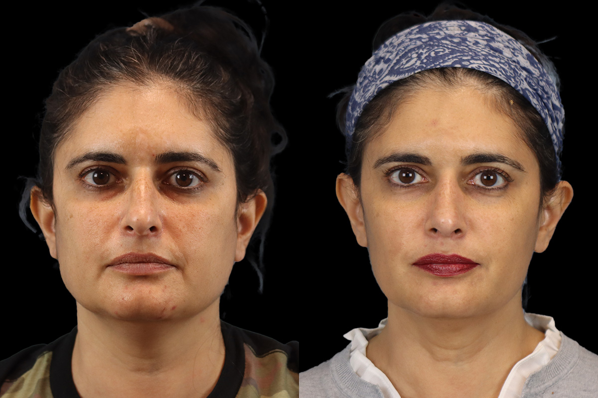 Rhinoplasty Before and After | Leong Facial Plastic Surgery