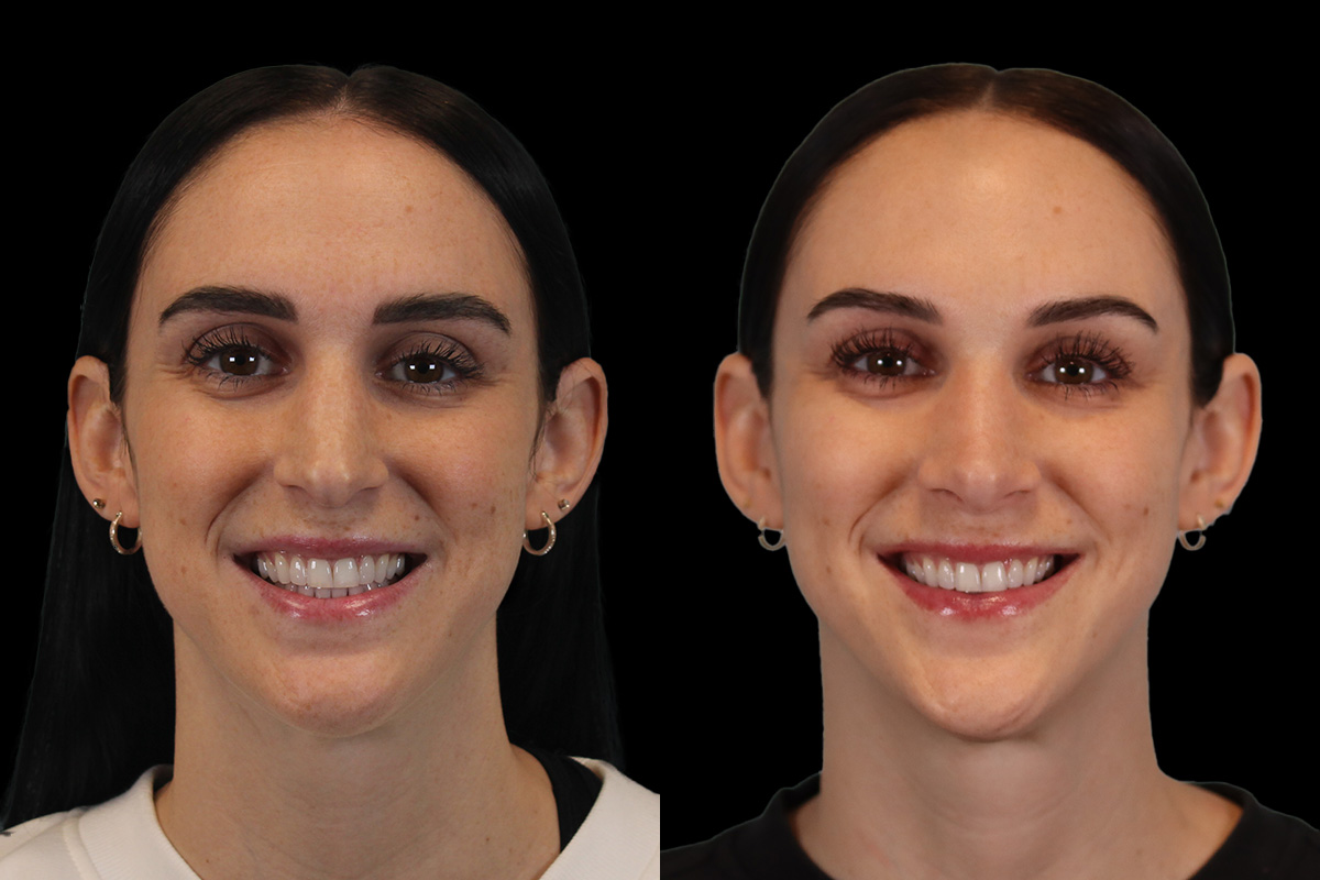 Rhinoplasty Before and After | Leong Facial Plastic Surgery