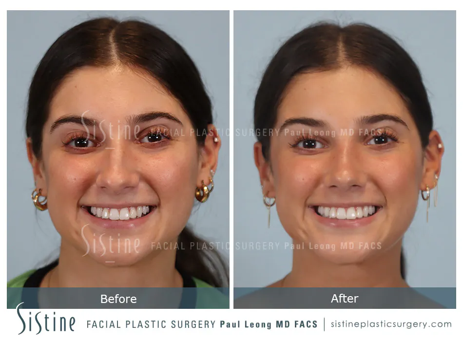 Rhinoplasty Before and After | Leong Facial Plastic Surgery