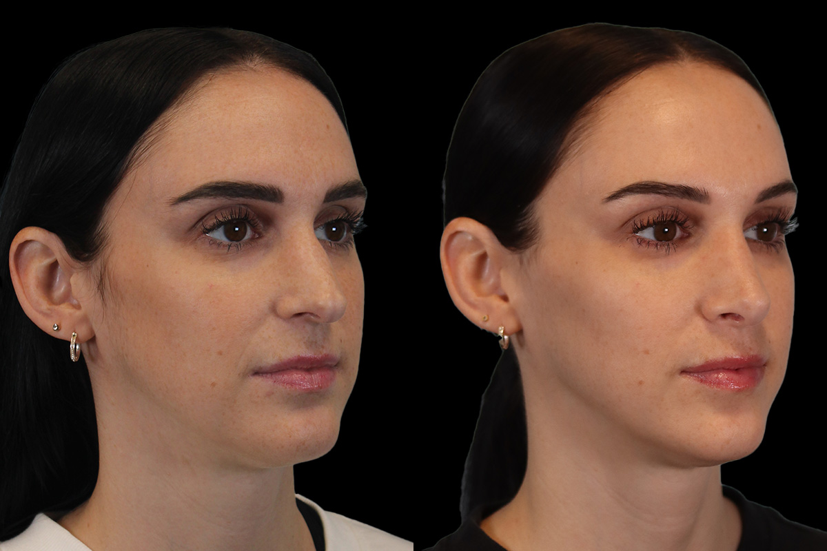 Rhinoplasty Before and After | Leong Facial Plastic Surgery