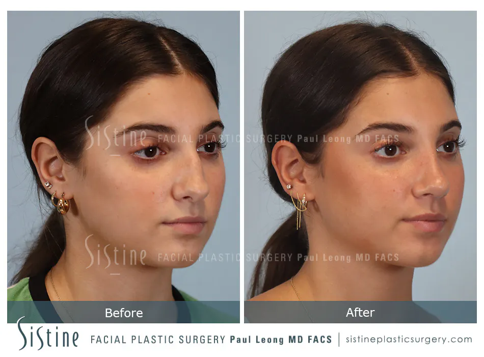 Rhinoplasty Before and After | Leong Facial Plastic Surgery
