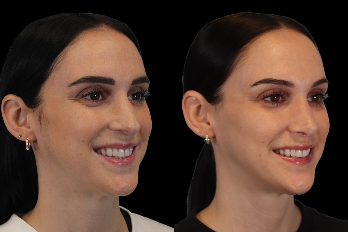 Rhinoplasty Before and After | Leong Facial Plastic Surgery