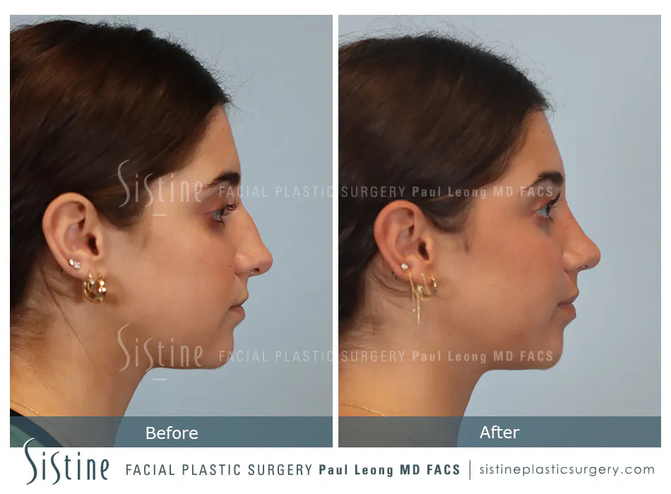 Rhinoplasty Before and After | Leong Facial Plastic Surgery
