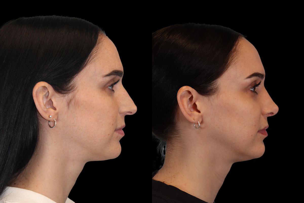 Rhinoplasty Before and After | Leong Facial Plastic Surgery