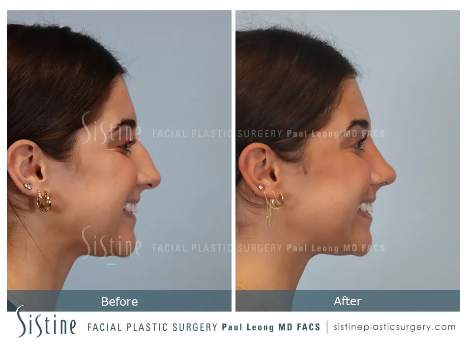 Rhinoplasty Before and After | Leong Facial Plastic Surgery
