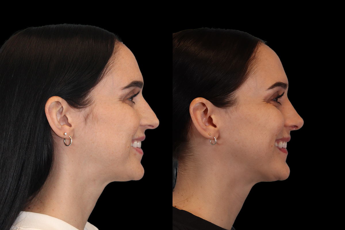 Rhinoplasty Before and After | Leong Facial Plastic Surgery