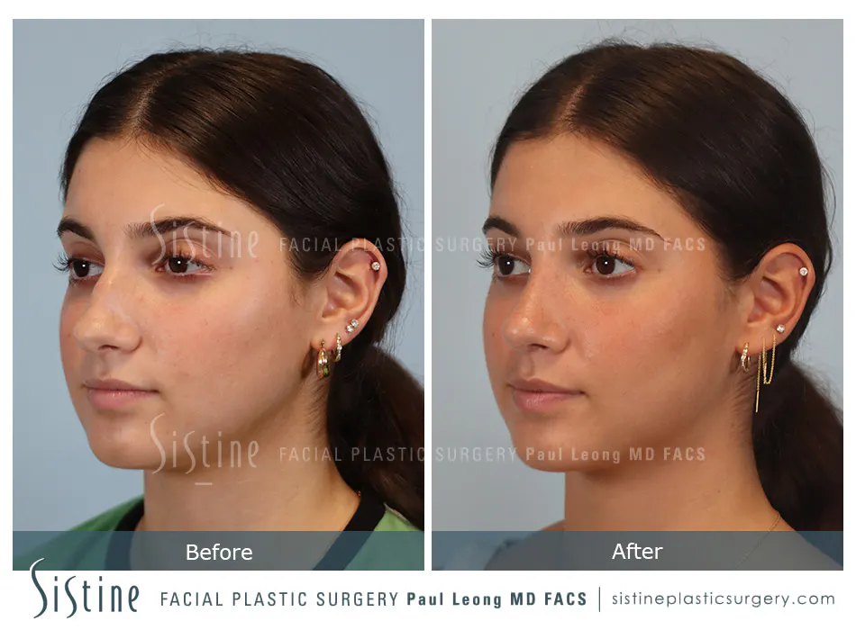Rhinoplasty Before and After | Leong Facial Plastic Surgery
