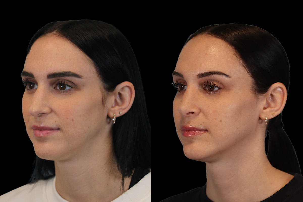 Rhinoplasty Before and After | Leong Facial Plastic Surgery