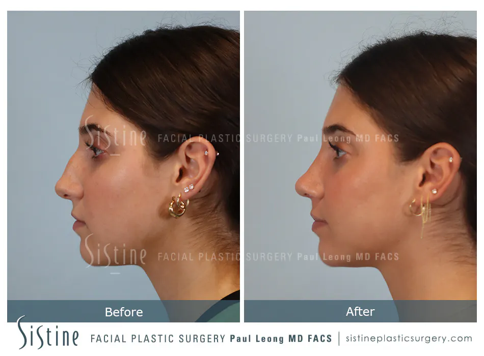 Rhinoplasty Before and After | Leong Facial Plastic Surgery