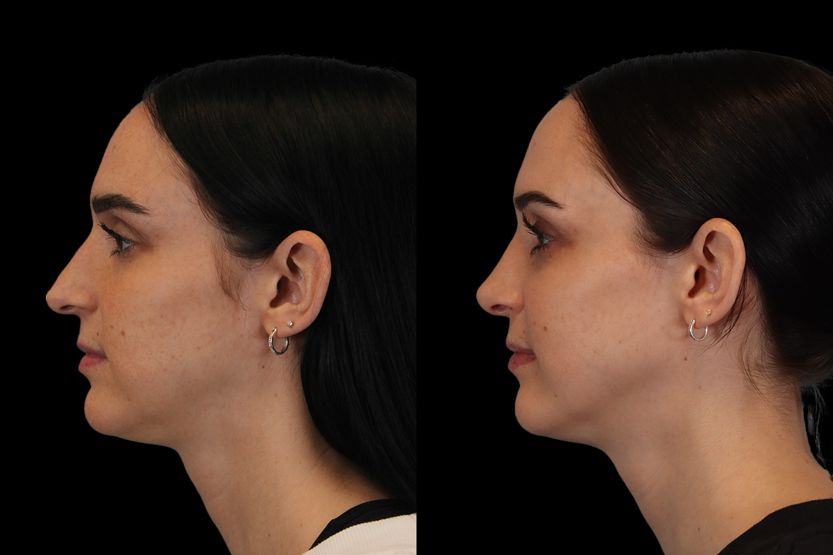 Rhinoplasty Before and After | Leong Facial Plastic Surgery