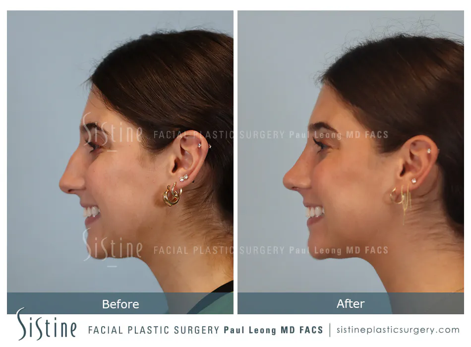 Rhinoplasty Before and After | Leong Facial Plastic Surgery