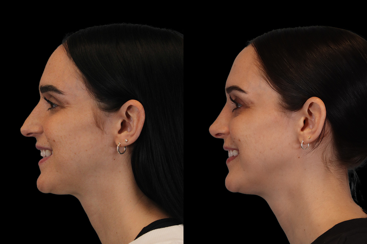 Rhinoplasty Before and After | Leong Facial Plastic Surgery