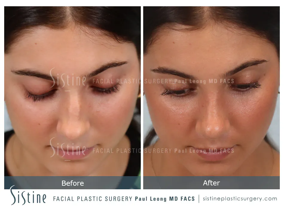 Rhinoplasty Before and After | Leong Facial Plastic Surgery