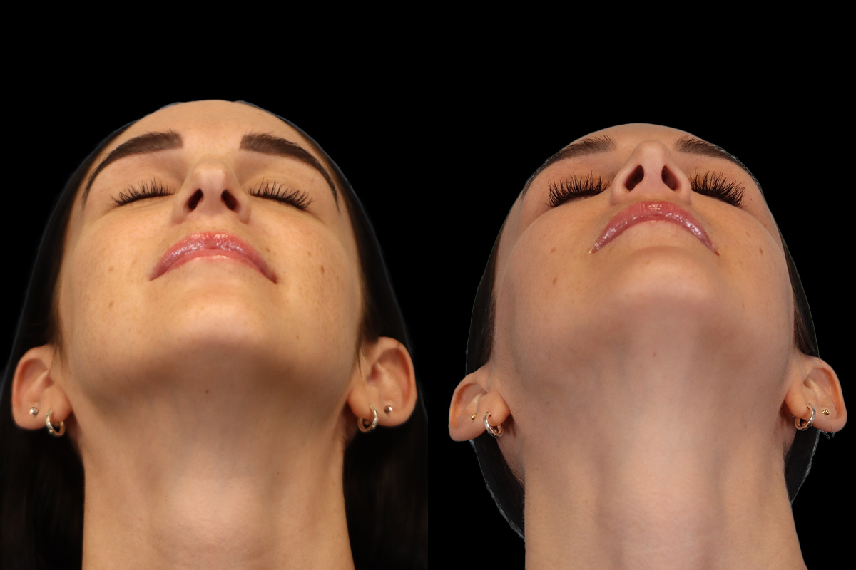 Rhinoplasty Before and After | Leong Facial Plastic Surgery