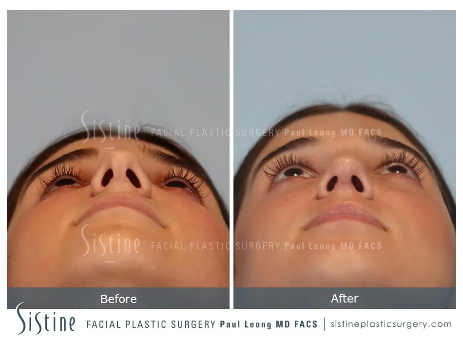 Rhinoplasty Before and After | Leong Facial Plastic Surgery