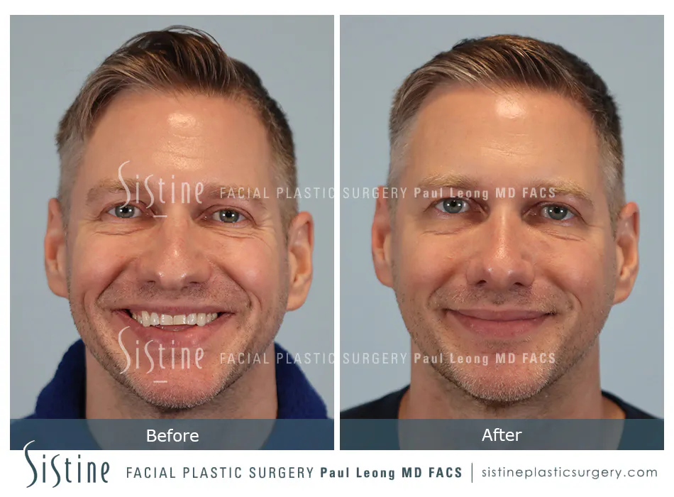 Rhinoplasty Before and After | Leong Facial Plastic Surgery