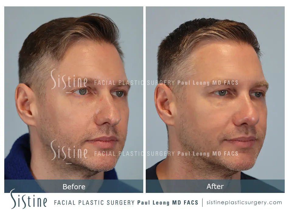 Rhinoplasty Before and After | Leong Facial Plastic Surgery