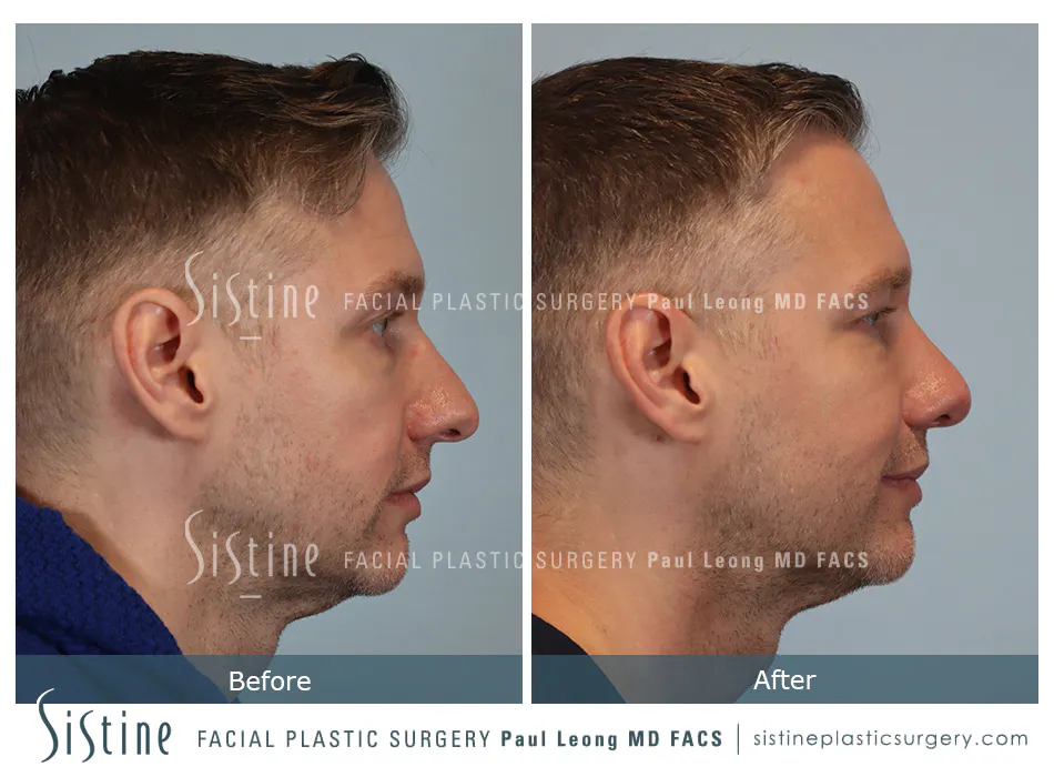 Rhinoplasty Before and After | Leong Facial Plastic Surgery