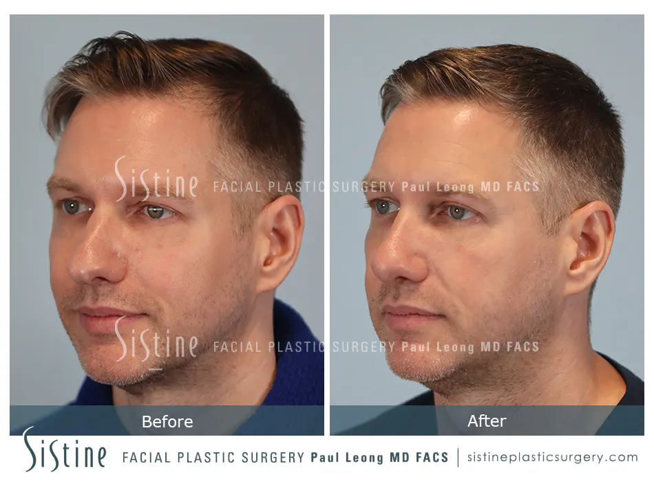 Rhinoplasty Before and After | Leong Facial Plastic Surgery
