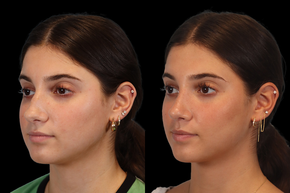 Rhinoplasty Before and After | Leong Facial Plastic Surgery