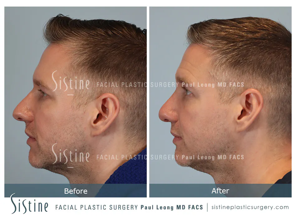 Rhinoplasty Before and After | Leong Facial Plastic Surgery