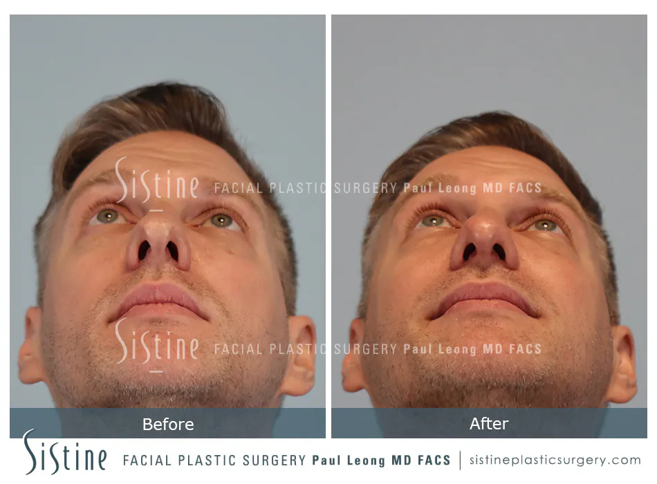 Nose Changes With Age - Preoperative View | Dr. Paul Leong