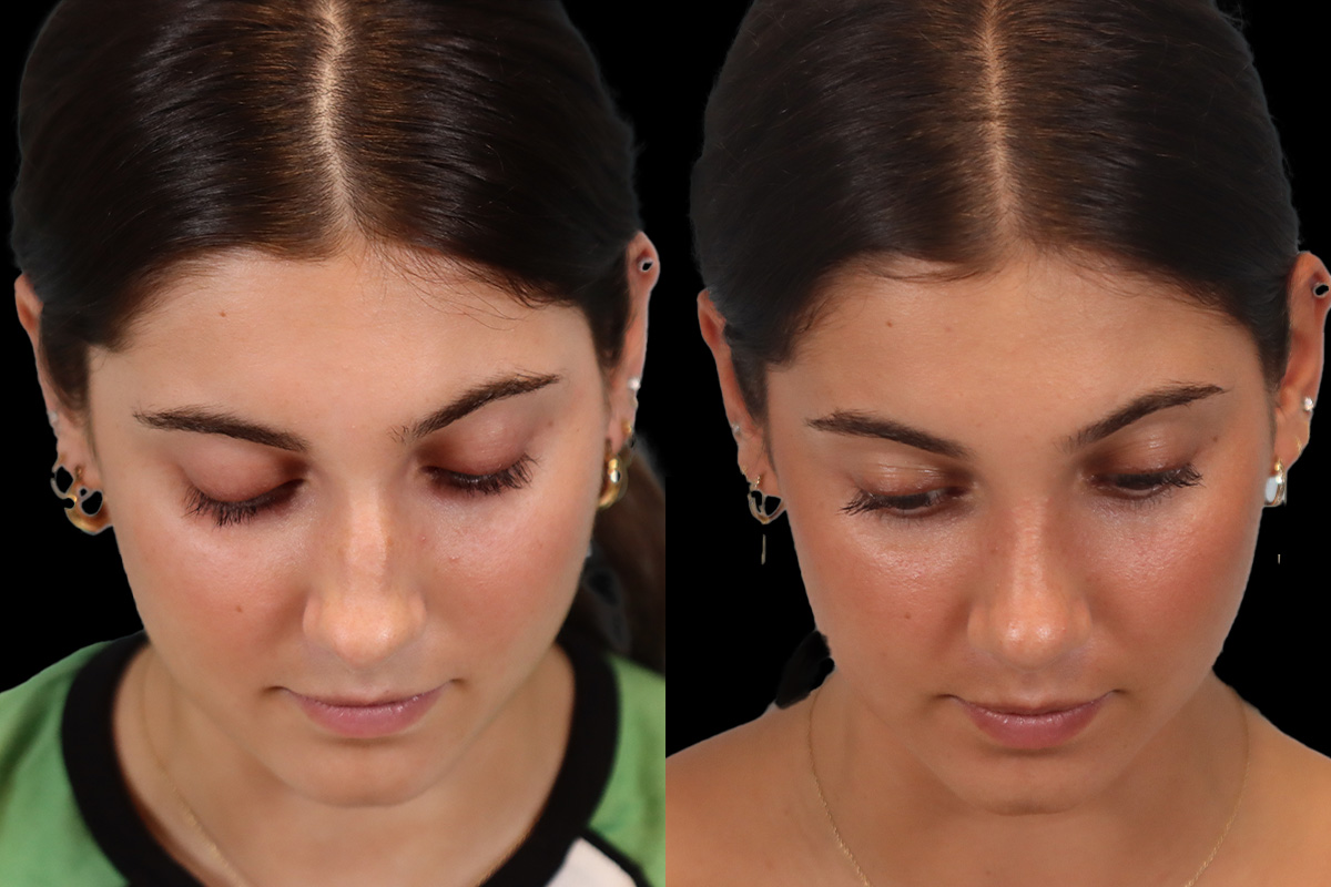 Rhinoplasty Before and After | Leong Facial Plastic Surgery