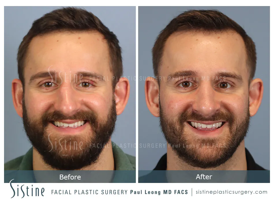 Rhinoplasty Before and After | Leong Facial Plastic Surgery