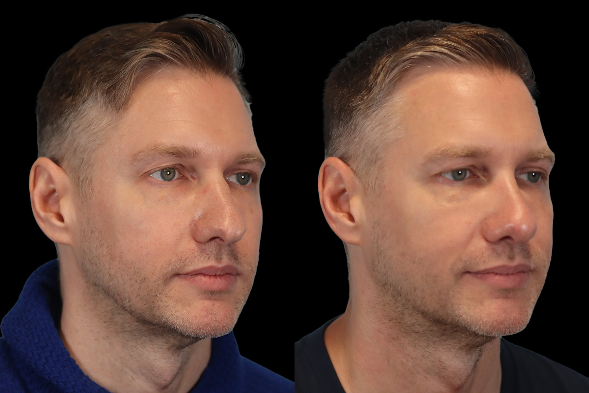 Rhinoplasty Before and After | Leong Facial Plastic Surgery