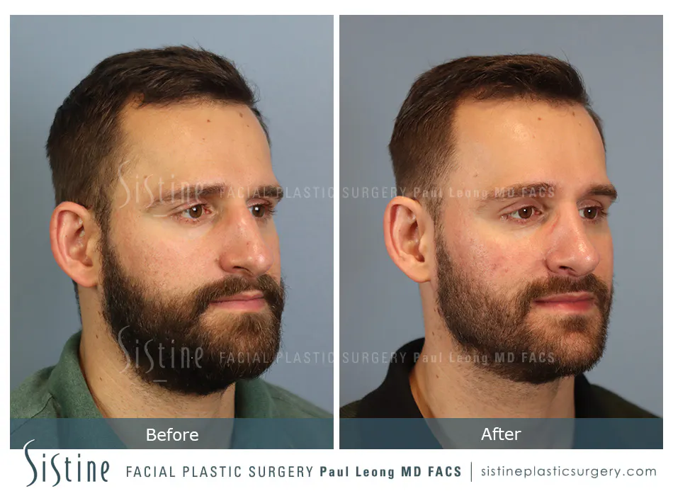 Rhinoplasty Before and After | Leong Facial Plastic Surgery