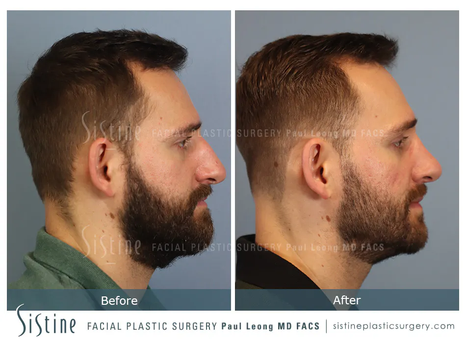 Rhinoplasty Before and After | Leong Facial Plastic Surgery