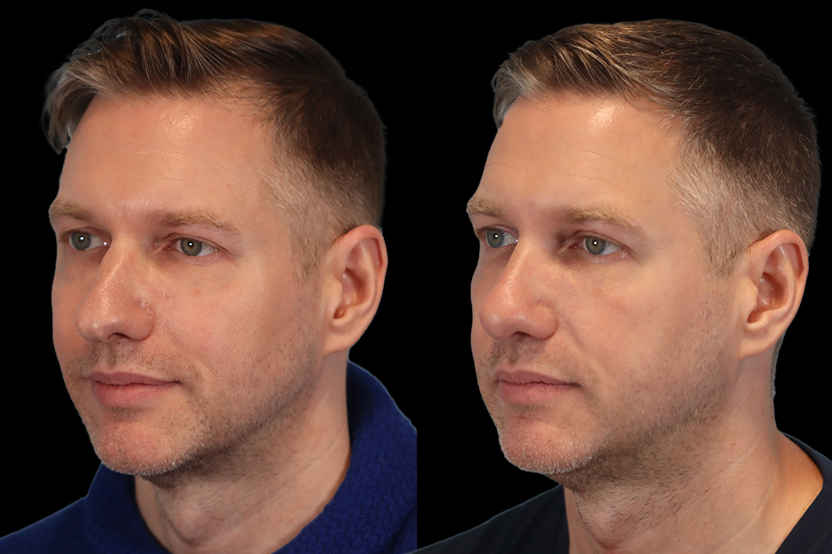 Rhinoplasty Before and After | Leong Facial Plastic Surgery