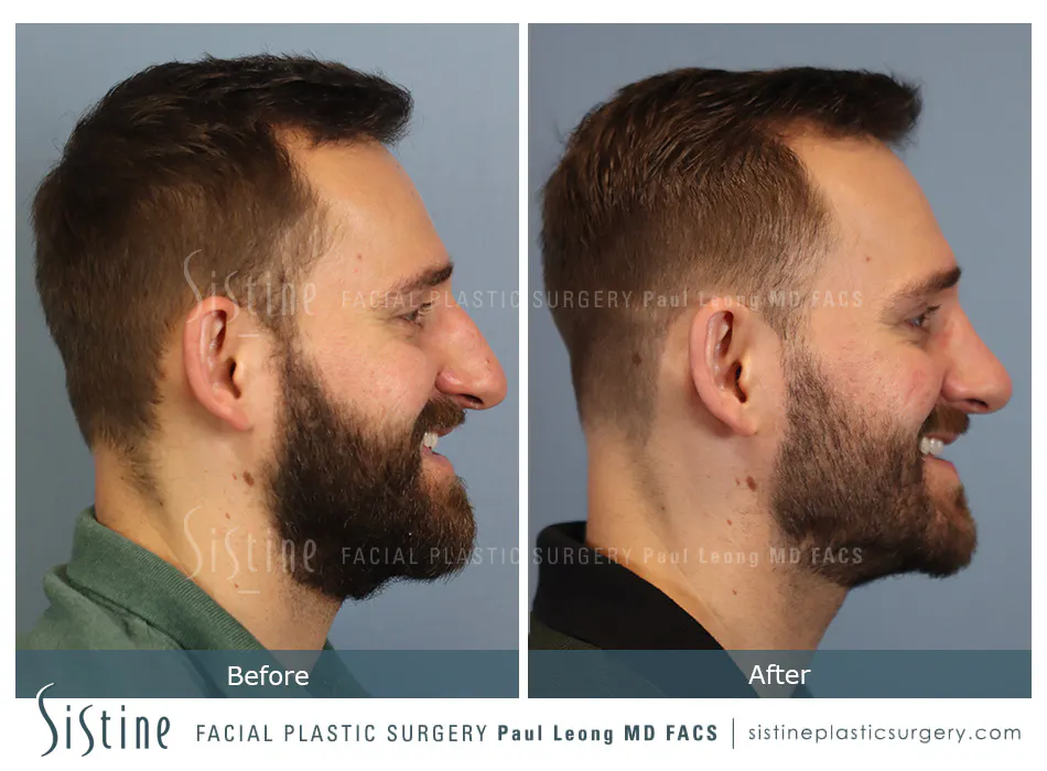 Rhinoplasty Before and After | Leong Facial Plastic Surgery